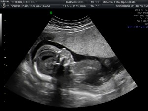 Ultrasound of William at 18 weeks